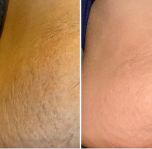 Stretch Mark Cream